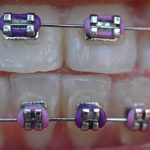 brackets